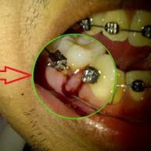 Kawat Behel Dapat Berbahaya Bagi Penggunanya