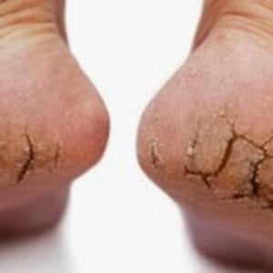 Sembuhkan Tumit Pecah-Pecah Dengan Cara Alami