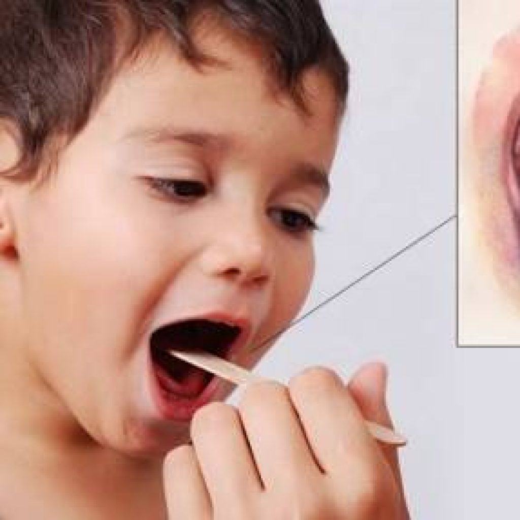 Satu Pasien RSMH Positif Difteri