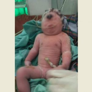 Heboh, Kelahiran Bayi Bermata Satu Buat Syok Orang Tua nya