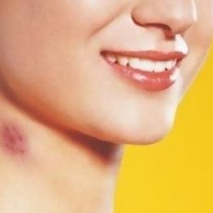 Begini Cara Sederhana Menghilangkan Cupang