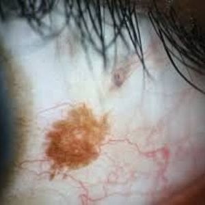 5 Tahun Derita Tumor Dimata, Giyem Butuh Uluran Tangan Pemerintah