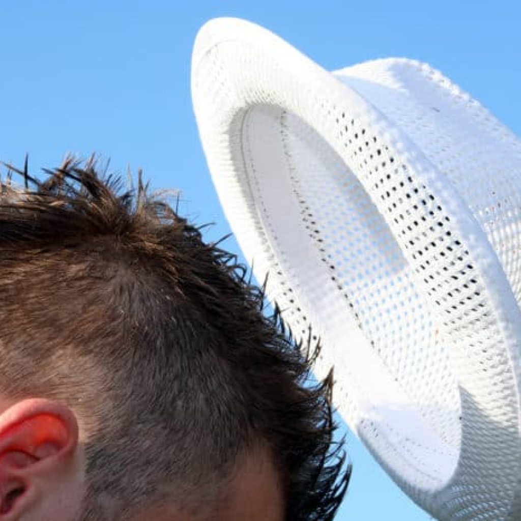 6 Cara Mudah Mengatasi Kulit Kepala Terbakar Matahari