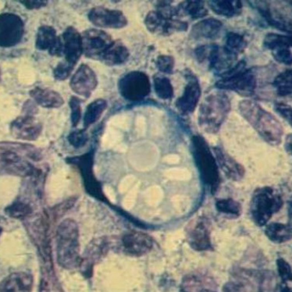 Pria Meninggal Terinfeksi Amuba Pemakan Otak Usai Berenang