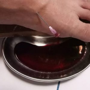 Mengenal Pengobatan Sunnah Al Fashdu