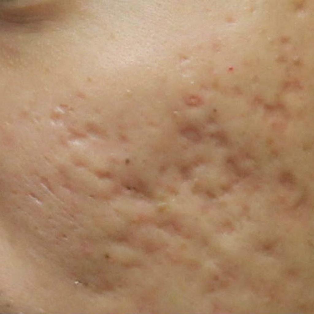 Cara Menghilangkan Bopeng Bekas Jerawat