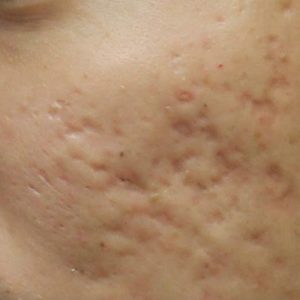 Cara Menghilangkan Bopeng Bekas Jerawat