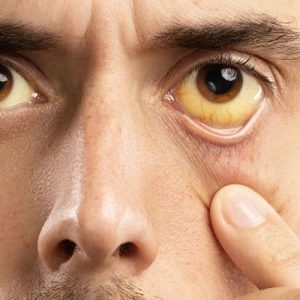 Adakah Obat Hepatitis A Khusus? Ini Cara Pengobatan Hepatitis A yang Tepat