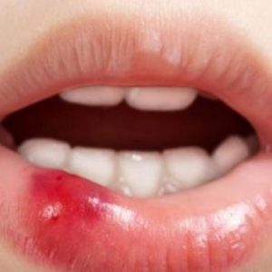 Beberapa Hal Yang Dapat Menyebabkan Sariawan Muncul Tiba-tiba