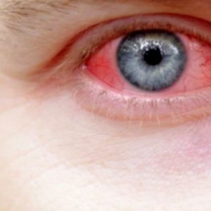 Mitos Mata Merah Akibat Konjungtivitis