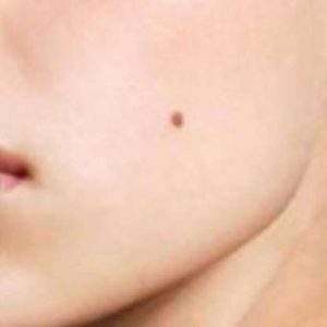 Cara Menghilangkan Tahi Lalat yang Mengganggu Penampilan