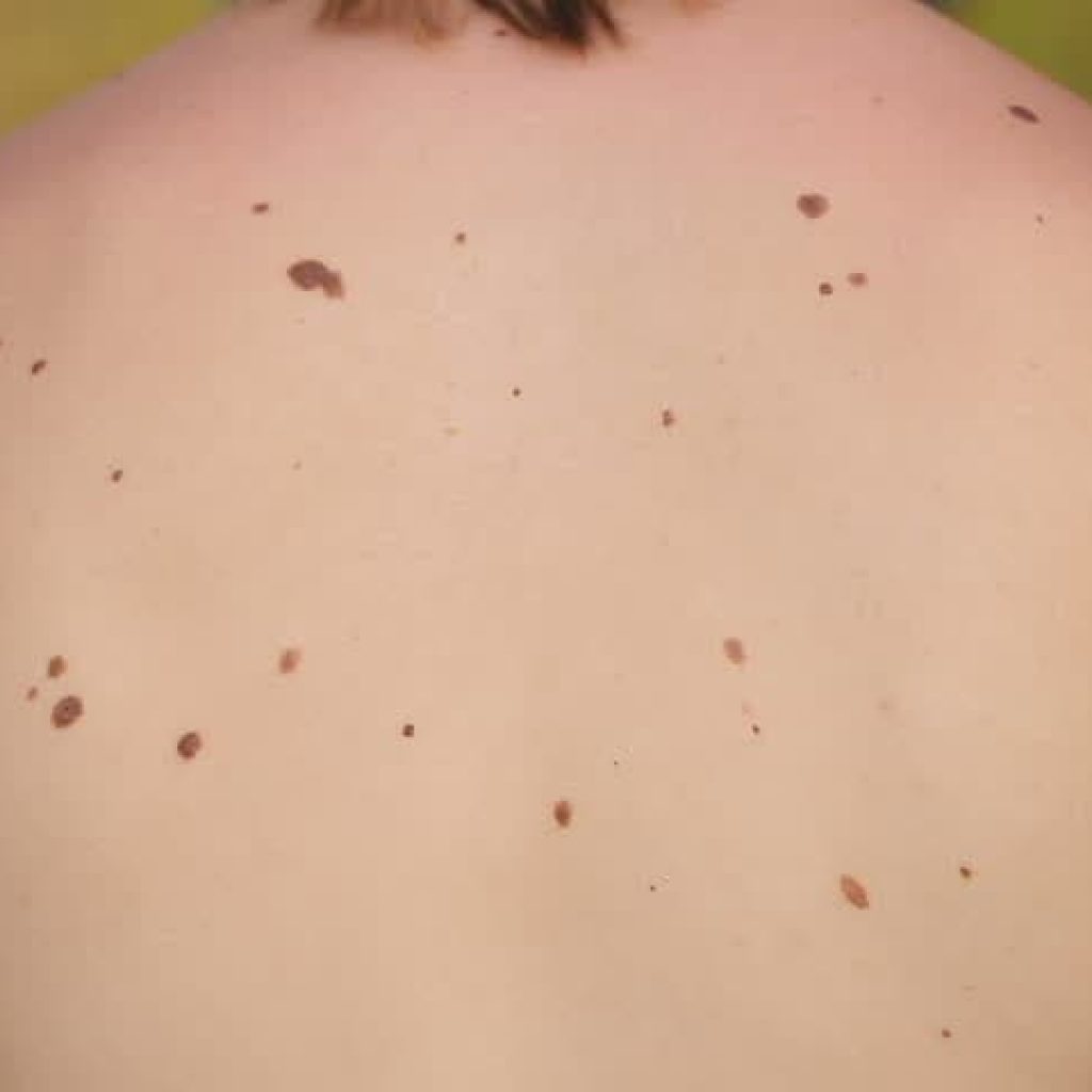 Ternyata Ini Penyebabnya,Tahi Lalat Anda Banyak?