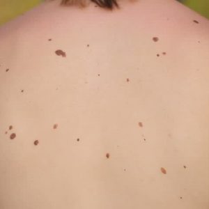 Ternyata Ini Penyebabnya,Tahi Lalat Anda Banyak?