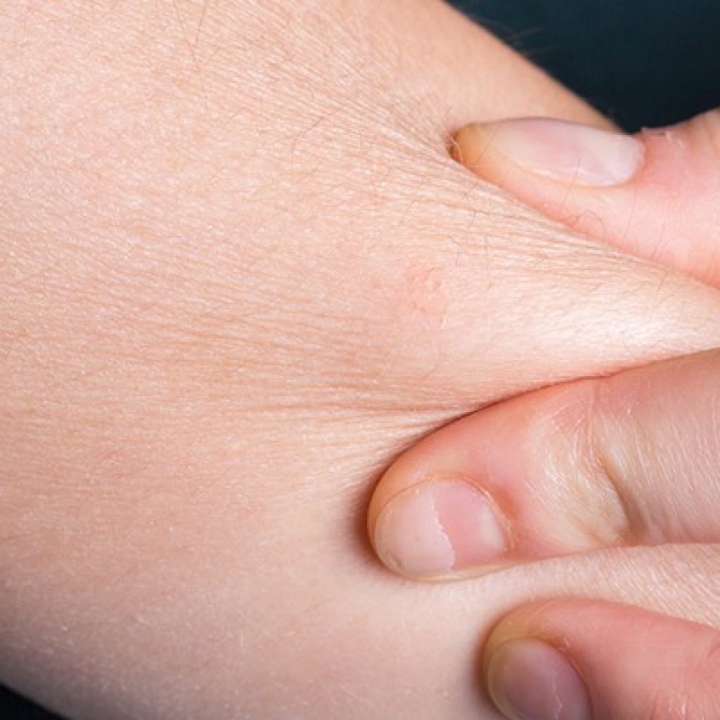 4 Cara Mencegah Kulit Kering dan Bersisik