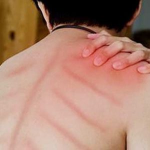 Amankah Anak Kerokan Saat Masuk Angin?