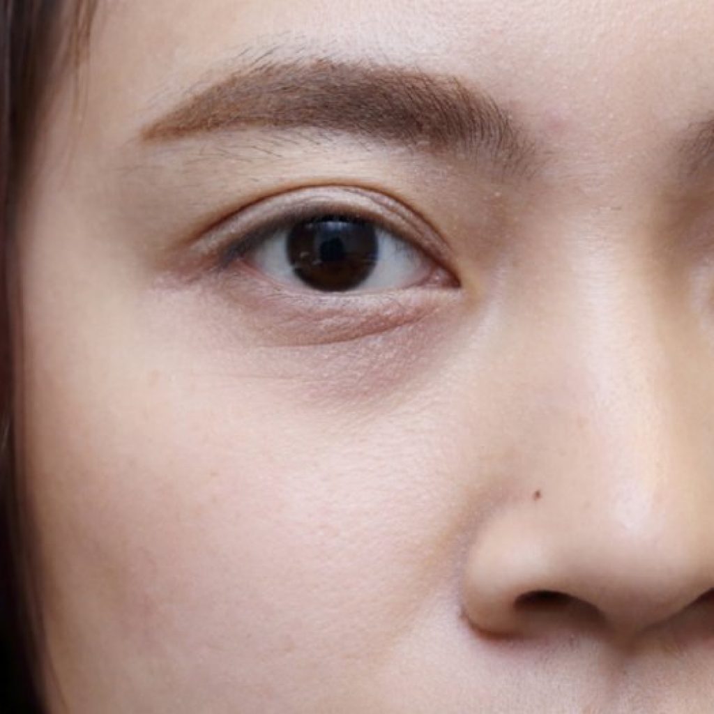 Memahami Penyebab Kantung Mata dan Cara Mengatasinya