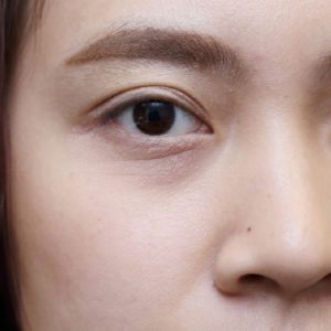 Memahami Penyebab Kantung Mata dan Cara Mengatasinya