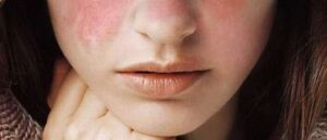 Berbahayakah Penyakit Lupus?