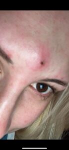 Beberapa Cara Mengatasi Bisul yang Perlu Anda Ketahui