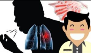 Dimasa Pandemi Covid-19, Penyakit TBC Patut Diwaspadai Dikabupaten Lahat