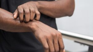 Tips Mudah Mencegah Gatal Karena Makanan