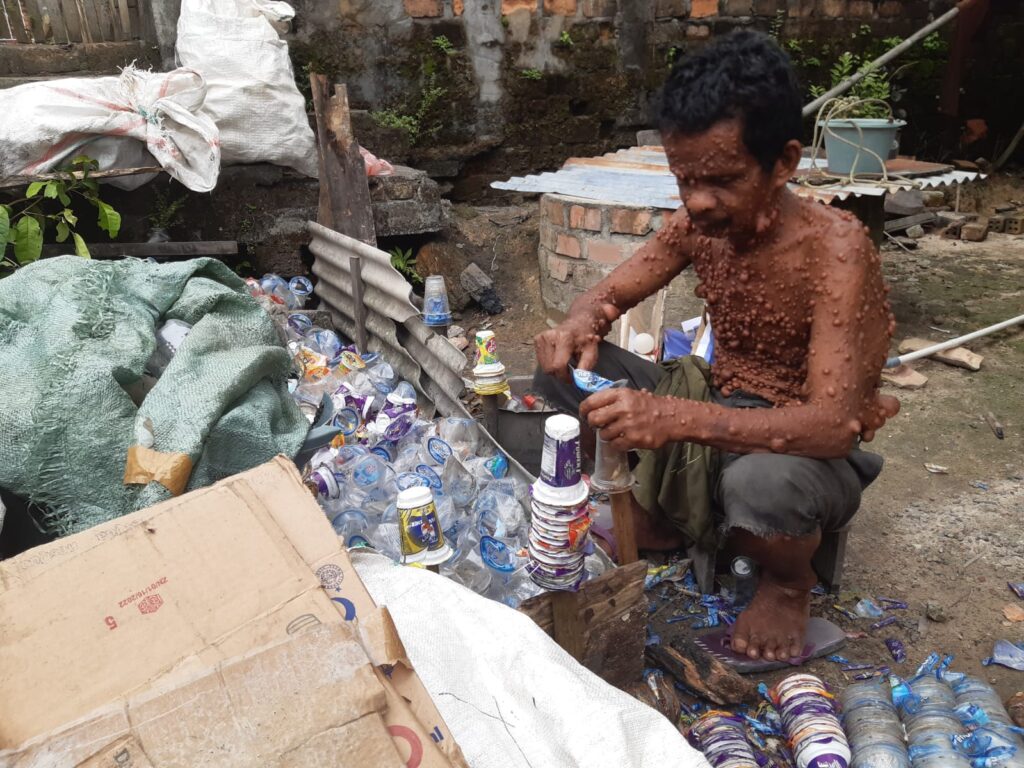 34 Tahun Mengidap Sakit Kulit, Pemulung Asal Ogan Ilir Ini Berharap Dukungan Biaya Pengobatan