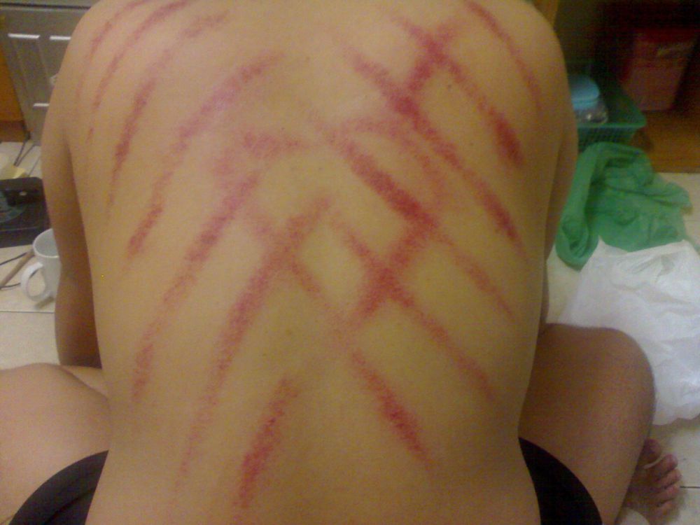 Begini Manfaat Kerokan dalam Mengatasi Masuk Angin