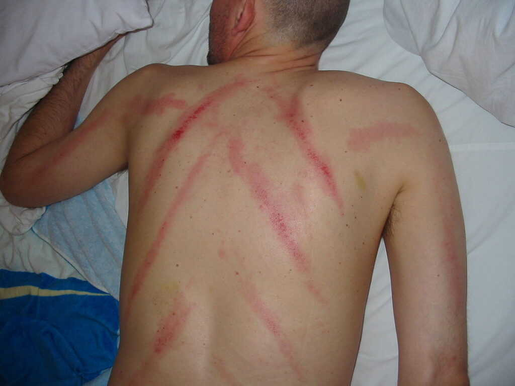 Ternyata Manfaat dan Risiko Kerokan dari Sisi Medis