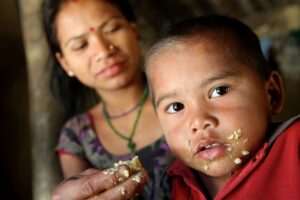 Penyebab dan Perawatan Penyakit Busung Lapar