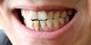 Cara Menghilangkan Kerak Gigi