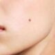 Fenomena Tahi Lalat Baru di Usia Dewasa: Antara Perubahan Hormon dan Sinyal Bahaya Kanker Kulit