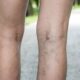 Mitos atau Fakta: Sering Melipat Kaki Bikin Varises? Ini Penyebab Aslinya!